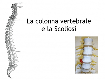 La colonna vertebrale  e la Scoliosi